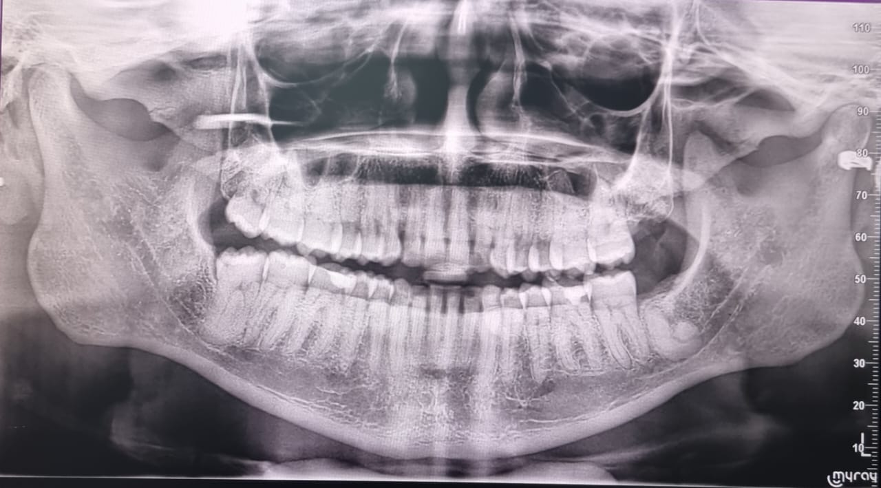 Caredent Patient Education DENTAL XRAY